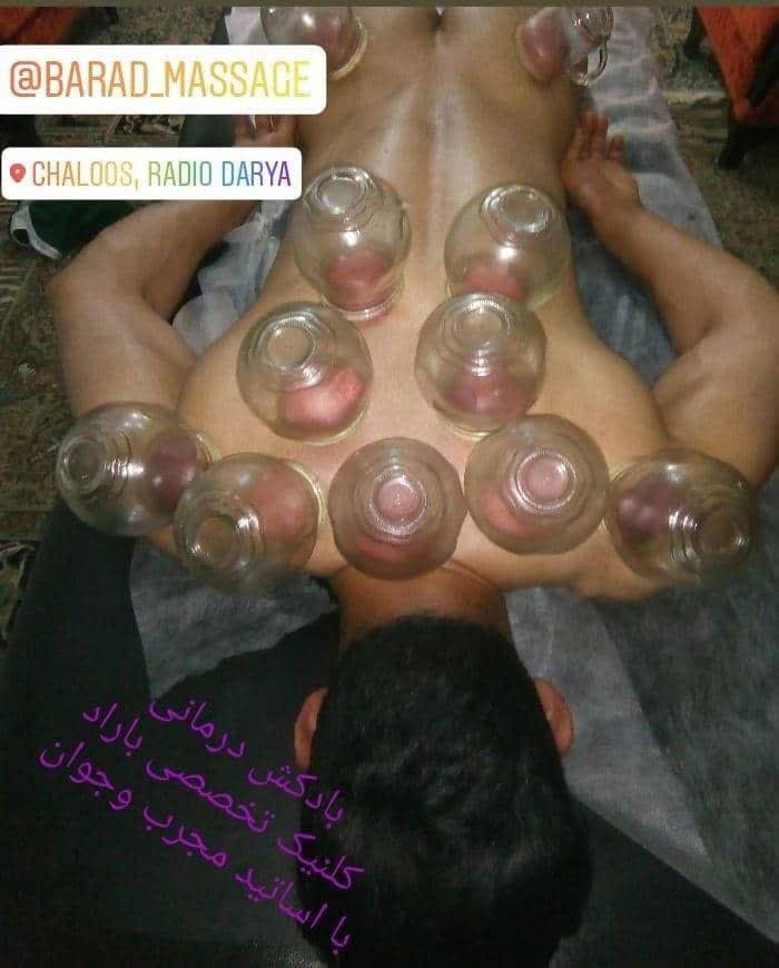 بادکش درمانی در باراد